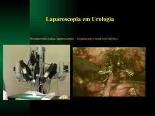Laparoscopia em Urologia Prostatectomia radical laparoscópica –  Enxerto nervo sural com DaVinci 