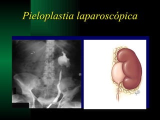 Pieloplastia laparoscópica 