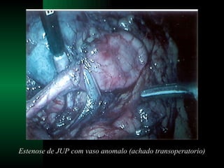 Estenose de JUP com vaso anomalo (achado transoperatorio) 