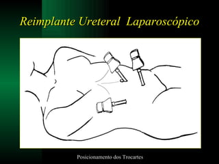 Reimplante Ureteral  Laparoscópico Posicionamento dos Trocartes 