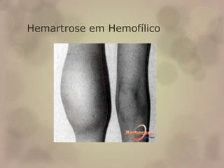 Hemartrose em Hemofílico
 