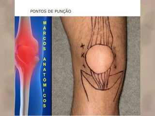 PONTOS DE PUNÇÃO
 