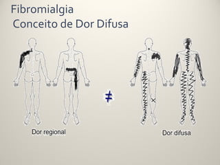 Fibromialgia
Conceito de Dor Difusa
 