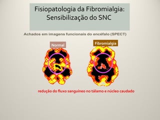 Fisiopatologia da Fibromialgia:
     Sensibilização do SNC


        Normal                  Fibromialgia




 redução do fluxo sanguíneo no tálamo e núcleo caudado
 