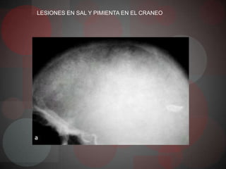 LESIONES EN SAL Y PIMIENTA EN EL CRANEO
 