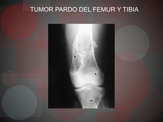 TUMOR PARDO DEL FEMUR Y TIBIA
 