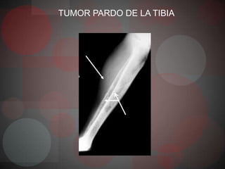 TUMOR PARDO DE LA TIBIA
 
