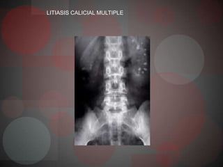 LITIASIS CALICIAL MULTIPLE
 