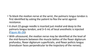 • To block the median nerve at the wrist, the palmaris longus tendon is
first identified by asking the patient to flex the wrist against
resistance.
• A short 22-gauge needle is inserted just medial and deep to the
palmaris longus tendon, and 3–5 mL of local anesthetic is injected
(Figure 46–26).
• With ultrasound, the median nerve may be identified at the level of
the mid-forearm between the muscle bellies of the flexor digitorum
profundus, flexor digitorum superficialis, and flexor pollicis longus
(transducer faces perpendicular to the trajectory of the nerves).
 