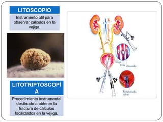 LITOSCOPIO
 Instrumento útil para
observar cálculos en la
        vejiga.




LITOTRIPTOSCOPÍ
       A
Procedimiento instrumental
  destinado a obtener la
   fractura de cálculos
 localizados en la vejiga.
 