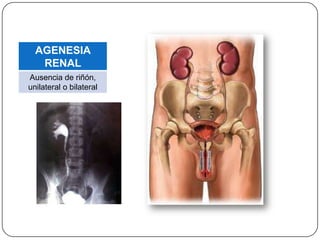 AGENESIA
   RENAL
Ausencia de riñón,
unilateral o bilateral
 