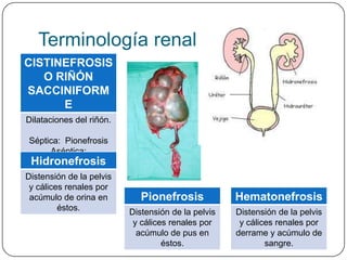 Terminología renal
CISTINEFROSIS
   O RIÑÓN
SACCINIFORM
      E
Dilataciones del riñón.

Séptica: Pionefrosis
     Aséptica:
Hidronefrosis
   Hidronefrosis
Distensión de la pelvis
 y cálices renales por
 acúmulo de orina en         Pionefrosis            Hematonefrosis
         éstos.           Distensión de la pelvis   Distensión de la pelvis
                           y cálices renales por     y cálices renales por
                            acúmulo de pus en       derrame y acúmulo de
                                   éstos.                   sangre.
 