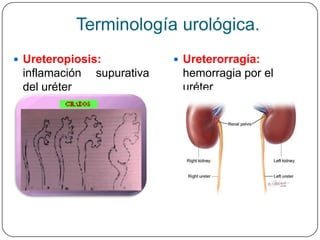 Terminología urológica.
 Ureteropiosis:             Ureterorragía:
 inflamación   supurativa    hemorragia por el
 del uréter                  uréter
 