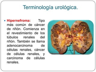 Terminología urológica.

 Hipernefroma:      Tipo
 más común de cáncer
 de riñón. Comienza en
 el revestimiento de los
 túbulos    renales   del
 riñón. También se llama
 adenocarcinoma        de
 células renales, cáncer
 de células renales, y
 carcinoma de células
 renales.
 