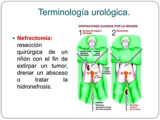 Terminología urológica.

 Nefrectomía:
 resección
 quirúrgica de un
 riñón con el fin de
 extirpar un tumor,
 drenar un absceso
 o      tratar     la
 hidronefrosis.
 