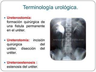 Terminología urológica.
 Epididimitis:            Litotomía:   extirpación
 inflamación aguda o       quirúrgica        ...