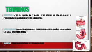 TERMINOS
- BOLSA PEQUEÑA EN EL COLON. ESTAS BOLSAS NO SON DOLOROSAS NI
PELIGROSAS A MENOS QUE SE INFECTEN O SE IRRITEN.
- CONDICIÓN QUE OCURRE CUANDO LAS BOLSAS PEQUEÑAS SOBRESALEN EN
LAS ÁREAS DÉBILES DEL COLON.
- PRIMERA PORCIÓN DEL INTESTINO DELGADO.
 