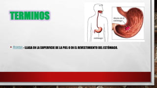 TERMINOS
- LLAGA EN LA SUPERFICIE DE LA PIEL O EN EL REVESTIMIENTO DEL ESTÓMAGO.
 