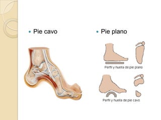 Pie cavoPie plano
