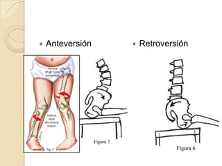 AnteversiónRetroversión