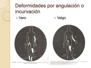 Deformidades por angulación o incurvaciónVaroValgo