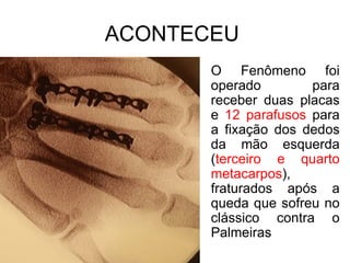 ACONTECEU
O Fenômeno foi
operado
para
receber duas placas
e 12 parafusos para
a fixação dos dedos
da mão esquerda
(terceiro e quarto
metacarpos),
fraturados após a
queda que sofreu no
clássico contra o
Palmeiras

 