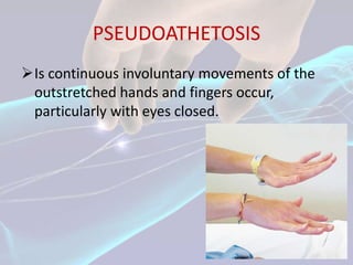 PSEUDOATHETOSIS
Is continuous involuntary movements of the
 outstretched hands and fingers occur,
 particularly with eyes closed.
 