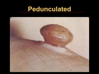 Pedunculated Rash Terminology used in oral pathology dental | PPT