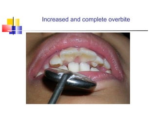 Overbite Calculation Terminology in Orthodontics | PPT