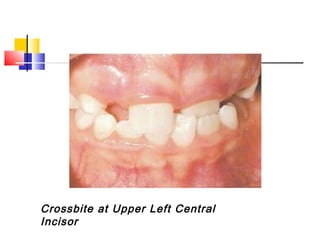 Left Crossbite Terminology in Orthodontics | PPT