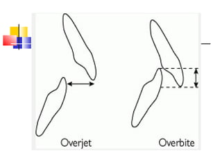 Over Byte Terminology in Orthodontics | PPT