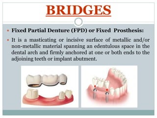 Terminology and classification of fixed prosthodontics | PDF