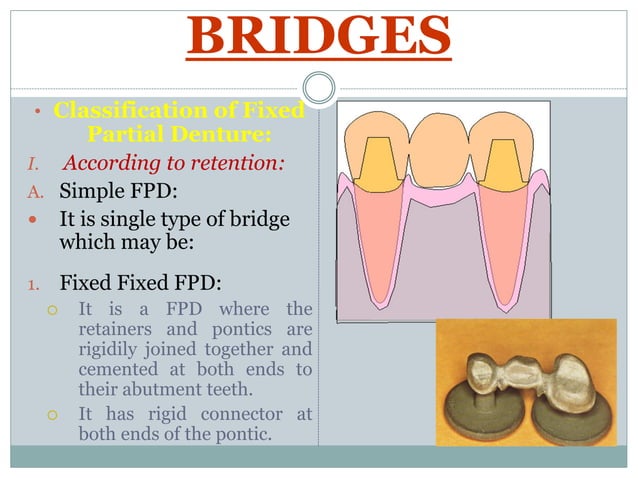 terminology-and-classification-of-fixed-prosthodontics-ppt