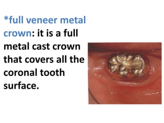 *full veneer metal
crown: it is a full
metal cast crown
that covers all the
coronal tooth
surface.
 