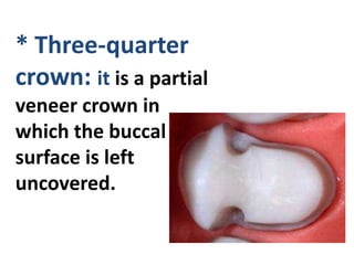 * Three-quarter
crown: it is a partial
veneer crown in
which the buccal
surface is left
uncovered.
 