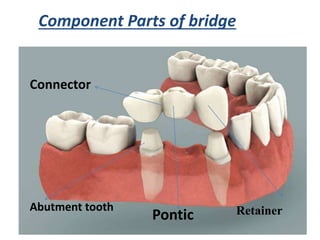 Component Parts of bridge
Abutment tooth Retainer
Pontic
Connector
 