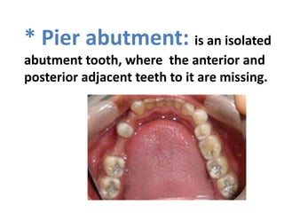 * Pier abutment: is an isolated
abutment tooth, where the anterior and
posterior adjacent teeth to it are missing.
 