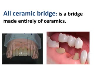 All ceramic bridge: is a bridge
made entirely of ceramics.
 
