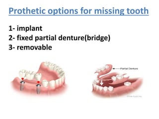 Prothetic options for missing tooth
1- implant
2- fixed partial denture(bridge)
3- removable
 
