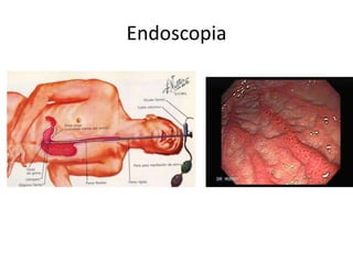 Endoscopia
