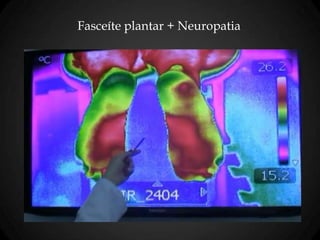 Fasceíte plantar + Neuropatia
 