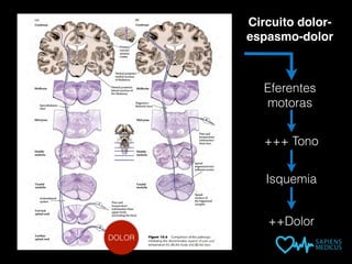 Circuito dolor-
espasmo-dolor
Eferentes
motoras
+++ Tono
Isquemia
++Dolor
DOLOR
 
