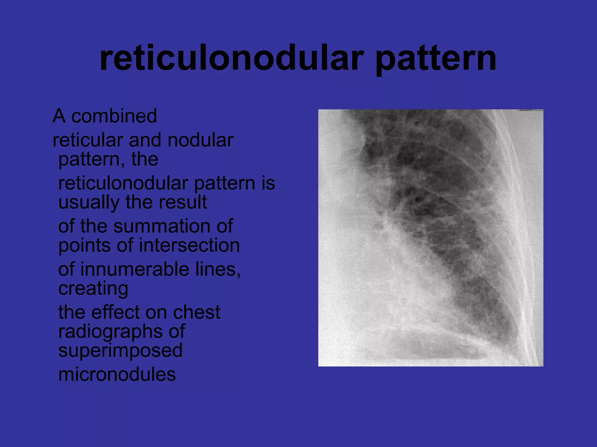 Thorax Rads Terms for thoracic imaging 3 | PPT