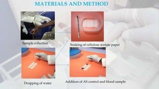 MATERIALS AND METHOD
Sample collection Soaking of cellulose acetate paper
Dropping of water Addition of AS control and blood sample
 