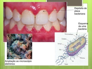 Depósito de placa bacteriana  Ampliação ao microscópio eletrónico Esquema de uma bactéria 