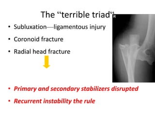 The “terrible triad“
• Subluxation—ligamentous injury
• Coronoid fracture
• Radial head fracture
• Primary and secondary stabilizers disrupted
• Recurrent instability the rule
 