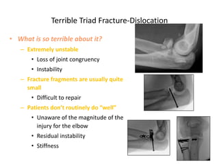 Terrible Triad Fracture-Dislocation
• What is so terrible about it?
– Extremely unstable
• Loss of joint congruency
• Instability
– Fracture fragments are usually quite
small
• Difficult to repair
– Patients don’t routinely do “well”
• Unaware of the magnitude of the
injury for the elbow
• Residual instability
• Stiffness
 