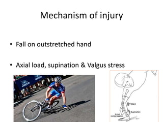 Mechanism of injury
• Fall on outstretched hand
• Axial load, supination & Valgus stress
 