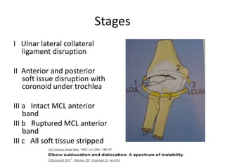 Stages
I Ulnar lateral collateral
ligament disruption
II Anterior and posterior
soft issue disruption with
coronoid under trochlea
III a Intact MCL anterior
band
III b Ruptured MCL anterior
band
III c All soft tissue stripped
 
