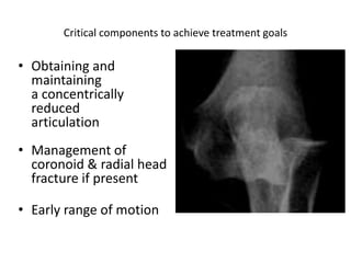 Critical components to achieve treatment goals
• Obtaining and
maintaining
a concentrically
reduced
articulation
• Management of
coronoid & radial head
fracture if present
• Early range of motion
 